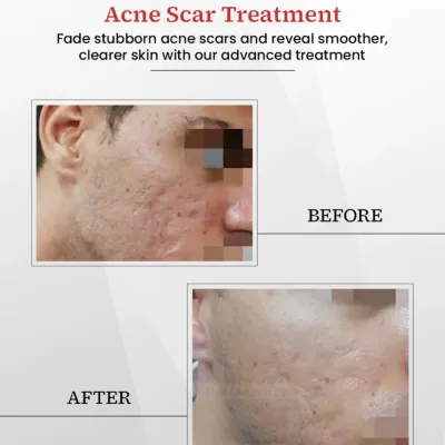 A clear before and after comparison of our advanced acne scar treatment. This result was achieved through a customized plan designed to fade stubborn marks and reveal smoother, healthier skin.