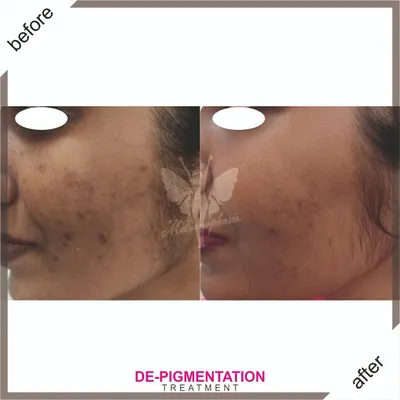 A fantastic result from our de-pigmentation treatment. This client saw a dramatic reduction in sun spots and uneven tone, achieving a much brighter and clearer complexion.