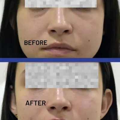 A clear before-and-after showcasing the results of filler treatment for under-eye hollows and smile lines. The 'after' image reveals a smoother transition under the eyes and softened nasolabial folds for a refreshed appearance.
