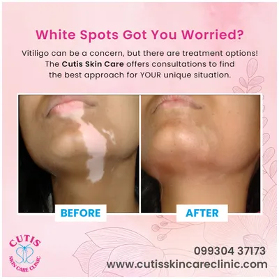 This powerful before and after image shows the significant improvement possible with our vitiligo treatments. We offer personalized consultations to find the best approach for your unique situation, helping to restore pigmentation and confidence.