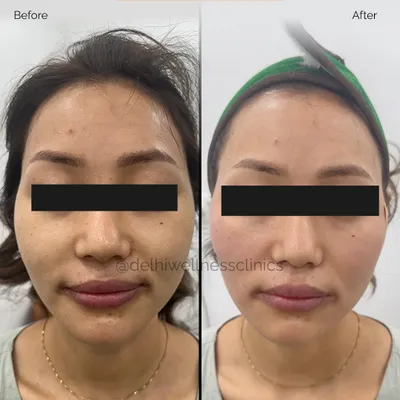 A clear demonstration of a thread lift's effectiveness. This before and after shows a significant reduction in sagging around the lower face and a beautifully contoured jawline. This is an ideal treatment for achieving a youthful lift without invasive surgery.