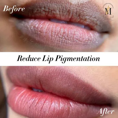 Lip pigmentation is a common concern, but it can be effectively treated. This before and after shows a significant reduction in darkness and an improvement in overall lip health and color.