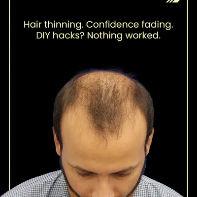 This is Dhruv Sharma before he began his journey with us. Like many, he was experiencing thinning hair and fading confidence after trying various DIY solutions that did not work.