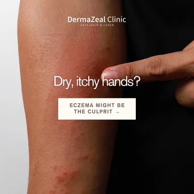 Dry, itchy hands can be a sign of eczema, a condition often triggered by daily irritants or allergens. Recognizing this is the first step toward finding a solution that works for you.