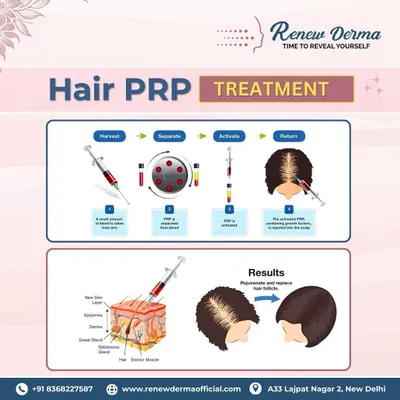 This graphic explains the four simple steps of a Hair PRP treatment: we harvest a small amount of your blood, separate the plasma, activate the growth factors, and return the activated PRP to your scalp. This process rejuvenates hair follicles for stronger growth.