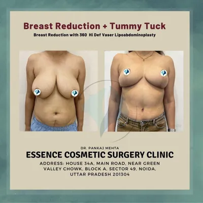 A frontal view of our complete Mommy Makeover, which included a breast reduction and a high-definition tummy tuck. This combination procedure addresses both the volume and position of the breasts and the shape of the abdomen for a balanced result.