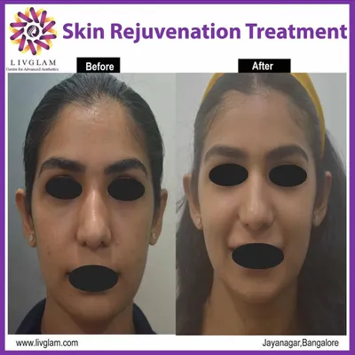 This client underwent a GFC (Growth Factor Concentrate) treatment to rejuvenate her skin. The 'after' photo shows improved skin texture, reduced blemishes, and an overall healthier, more vibrant complexion.
