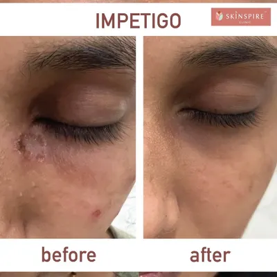 This before and after shows the successful treatment of Impetigo, a bacterial skin infection. It is important to consult a dermatologist for such conditions to get a proper diagnosis and effective antibiotic treatment.