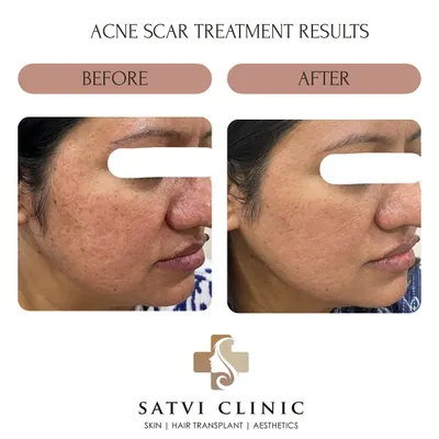 This patient shows a significant reduction in scar depth and improved skin texture after a combination of Microneedling and Fractional CO₂ Laser sessions. This approach helps to remodel collagen and smooth the skin's surface over time.