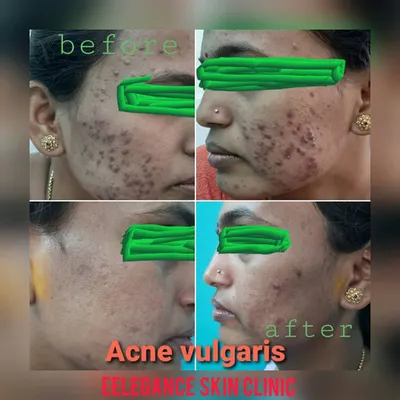A clear view of the progress made in treating severe acne vulgaris. My goal is to not only treat the condition but also restore my patient's confidence.