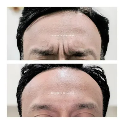 A clear example of how Botox effectively smooths dynamic forehead wrinkles caused by muscle movement. The result is a serene, youthful brow without a "frozen" look.