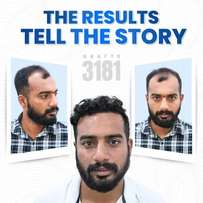 For Mr. Devi Prasad, the goal was to bring back the version of himself he missed. By implanting 3,181 grafts, I was able to fill in the thinning areas and rebuild a strong, natural-looking hairline that completely transformed his appearance.