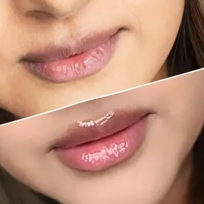 This transformation focused on correcting mild pigmentation on the upper lip and adding a soft, warm color. The result is a balanced, healthy-looking pout with a subtle shine, enhancing the client's natural lip shape.