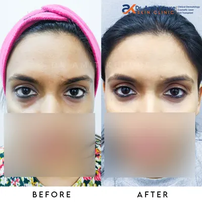 This before and after shows the immediate effect of tear trough fillers. This non-surgical treatment restores volume under the eyes, significantly reducing the appearance of hollows and dark circles for a refreshed, well-rested look.