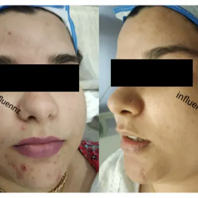 A side-by-side comparison showing a significant reduction in active acne and inflammation on the chin and cheek area after a personalized treatment course.