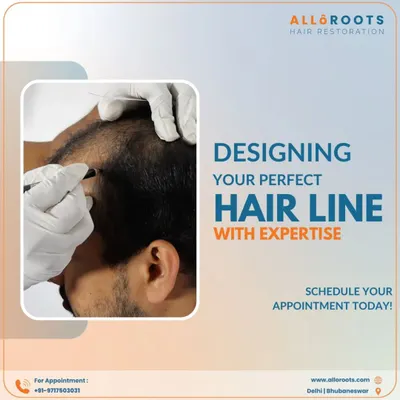 Designing the perfect hairline is a blend of art and science. I meticulously plan the hairline to suit your facial structure and age, ensuring the final result is both natural and aesthetically pleasing. Your journey to a renewed look starts with this crucial planning phase.