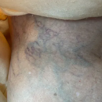 This image shows the initial state of severe varicose veins on a client's leg before beginning treatment. Such conditions can cause significant aching, heaviness, and swelling.