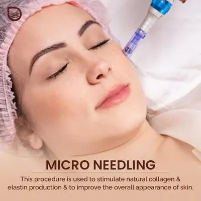 Microneedling is a procedure I use to stimulate natural collagen and elastin production. It is highly effective for improving the overall appearance of the skin, especially for acne scars and fine lines.