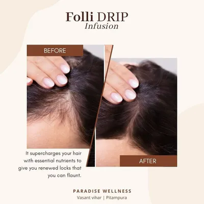 This powerful before and after image demonstrates the efficacy of our Folli IV Drip. By supercharging the body with essential nutrients, this therapy promotes renewed locks that are visibly thicker and healthier.