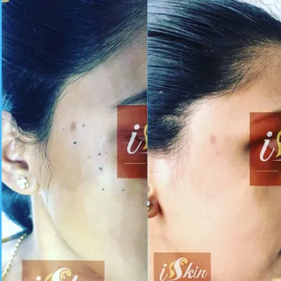A patient's result after a non-surgical procedure to remove multiple moles from the side of her face. The treatment left the skin clear and smooth, without any scarring.