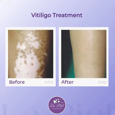 This before-and-after image is a powerful example of a successful vitiligo treatment. Our goal is to help restore pigmentation and achieve a more even skin tone, and this result showcases the visible progress that is possible with a dedicated and medically supervised plan.