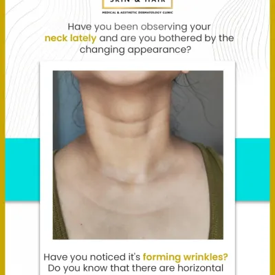 The appearance of horizontal wrinkles and vertical bands on the neck is a common concern. This image highlights the issues I frequently address, helping patients understand what to look for and that effective solutions are available.