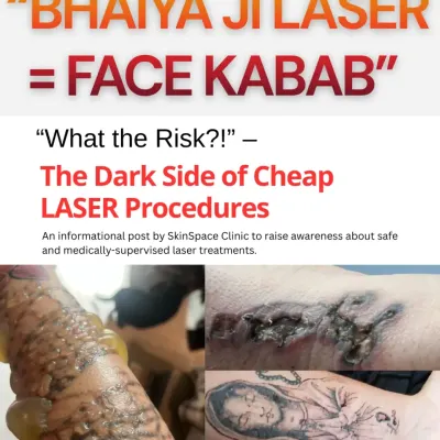 The phrase "Bhaiya Ji Laser = Face Kabab" might sound funny, but the reality is terrifying. This image shows the dark side of cheap laser procedures, including severe blistering and burns from tattoo removal attempts by untrained operators.