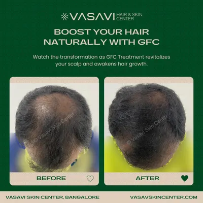 This before and after comparison shows a significant increase in hair density for a patient after completing a course of GFC treatments. The therapy naturally revitalized the scalp and awakened dormant hair follicles for substantial regrowth.