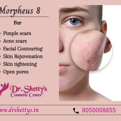 Morpheus8 is one of my most effective treatments for skin texture issues. It helps with reducing the appearance of acne scars, pimple marks, and open pores, while also providing skin tightening and facial contouring for overall skin rejuvenation.