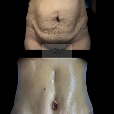 This is a powerful transformation achieved with an abdominoplasty, or tummy tuck. The procedure is ideal for mothers seeking to address loose skin and separated abdominal muscles after childbirth, resulting in a significantly flatter and more toned stomach.