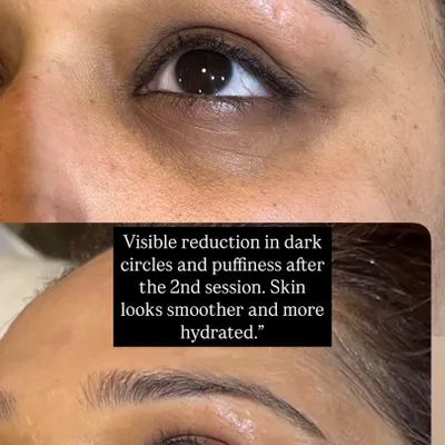 A close-up look at the reduction in dark circles and puffiness after just two sessions. The skin under the eye is visibly smoother, brighter, and more hydrated, showcasing the effectiveness of my targeted eye treatment.