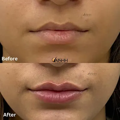 A perfect example of subtle and natural lip enhancement. We added just enough volume to create a fuller shape and define the cupid's bow, resulting in beautifully balanced lips.