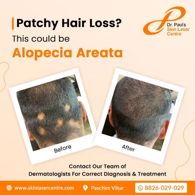 This before and after comparison shows the successful outcome of our treatment for Alopecia Areata. The patient's patchy hair loss was resolved, leading to full and healthy hair coverage across the scalp.