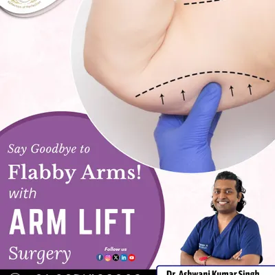 An arm lift is the definitive solution for "bat wings" or flabby arms caused by excess, sagging skin. The procedure creates a tighter, more toned appearance.
