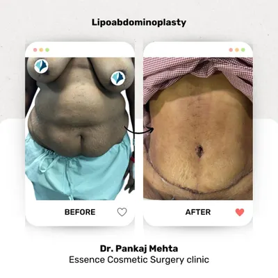 A clear and simple before and after of a lipoabdominoplasty. This image effectively shows the removal of excess skin and fat, resulting in a flatter, smoother abdomen and a repositioned navel for a natural look.