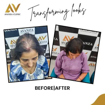 This before and after collage shows a significant improvement in hair density for one of our female clients, restoring fullness and confidence.