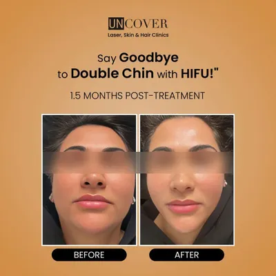 This before-and-after photo shows the power of HIFU to redefine the jawline by treating a double chin. The result is a visibly slimmer and more sculpted facial profile.