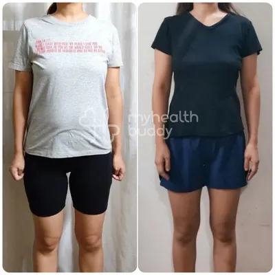 This is a powerful Diastasis Recti transformation. With targeted exercises, we were able to significantly close the abdominal separation and rebuild core function.