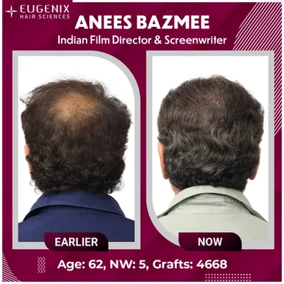 A complete view of Director Anees Bazmee's transformation from all angles, showing the density and natural hairline we created.
