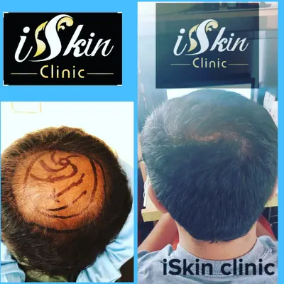This before and after comparison demonstrates the effectiveness of our hair transplant service. We focus on creating a dense and natural hairline, addressing the core issue of hair loss with a permanent solution performed by our surgical experts.