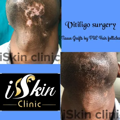 This before and after result on the neck and jawline was achieved through vitiligo surgery. We utilized tissue grafts derived from FUE hair follicles to successfully reintroduce pigment into the white patches, showcasing a key area of our surgical expertise.