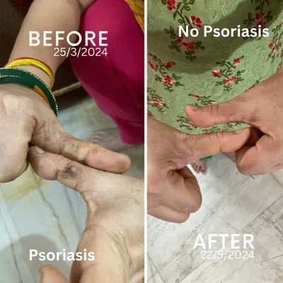 This is a two-month transformation of my mother's Psoriasis, a condition doctors called incurable. The 'before' image shows the inflammation on her finger, and the 'after' shows her skin completely healed through a dedicated Yogic and Ayurvedic regimen.
