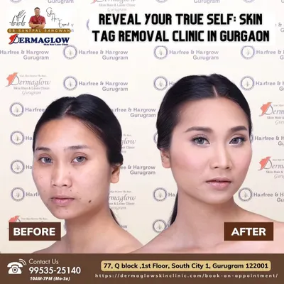 A detailed look at a client's results after undergoing our radiofrequency procedure for multiple facial skin tags. The treatment reveals clearer and smoother skin, significantly enhancing their natural appearance.
