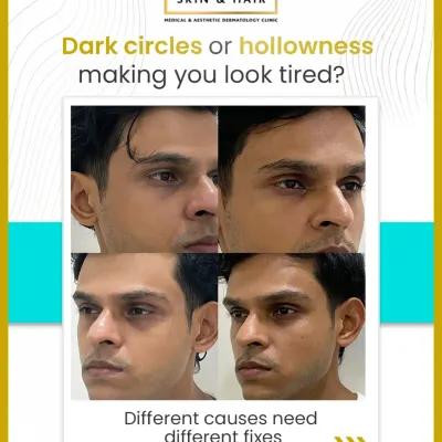 Hollowness and dark circles can make you look tired regardless of how much you rest. Because there are different causes, from volume loss to pigmentation, a customized approach is necessary for effective treatment.