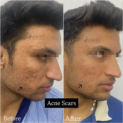 This before-and-after shows the significant improvement possible for deep acne scars. We used a combination of subcision to break up the scar tissue, lasers to resurface the skin, and a fat transplant to restore lost volume, achieving a much smoother texture after just three sessions.
