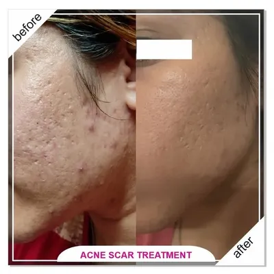 A remarkable improvement in deep, pitted acne scars after a customized treatment plan. We used a combination of CO2 laser and MNRF to remodel the skin's surface.