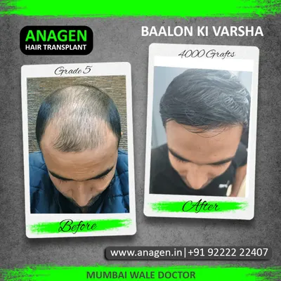 We call this result "Baalon ki Varsha" or a shower of hair. This patient received 4000 grafts to address Grade 5 baldness, resulting in a full, dense head of hair that completely transformed his appearance.