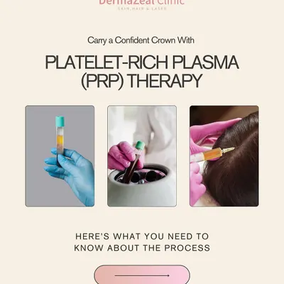 This graphic provides a clear overview of the Platelet-Rich Plasma (PRP) therapy process. It is a three-step medical treatment where a person's blood is drawn, processed, and then injected into the scalp to encourage new hair growth.