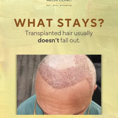 A common question is: does transplanted hair fall out? The hair from the donor area is permanent and typically does not fall out.