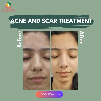 This powerful before-and-after transformation shows the results of our personalized acne and scar treatment. We effectively reduced inflammation, cleared breakouts, and significantly faded post-acne marks, revealing smoother, clearer skin.
